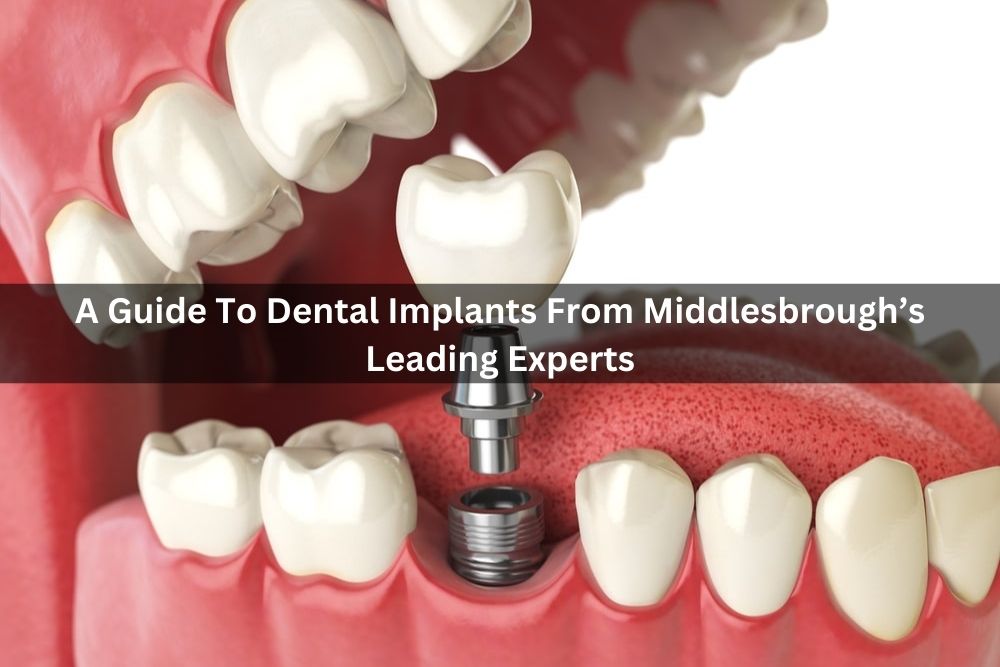 A Guide To Dental Implants From Middlesbrough’s Leading Experts